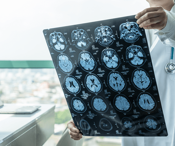 A healthcare professional holding and examining a large sheet of brain scan images, showing multiple MRI or CT scan slices of a brain, likely for diagnosing or assessing traumatic brain injury.
